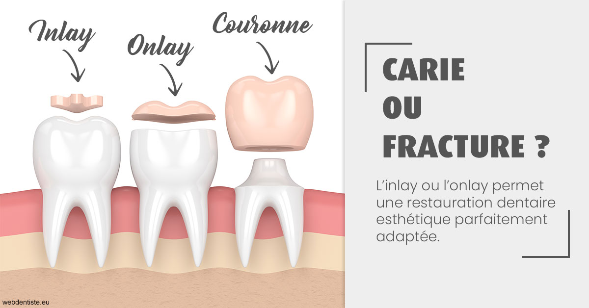 https://dr-guerrier-thierry.chirurgiens-dentistes.fr/T2 2023 - Carie ou fracture 1