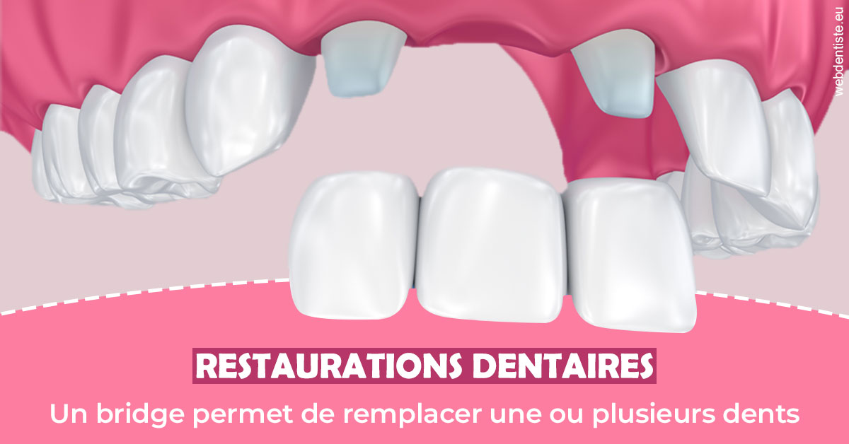 https://dr-guerrier-thierry.chirurgiens-dentistes.fr/Bridge remplacer dents 2