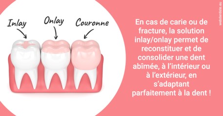 https://dr-guerrier-thierry.chirurgiens-dentistes.fr/L'INLAY ou l'ONLAY 2
